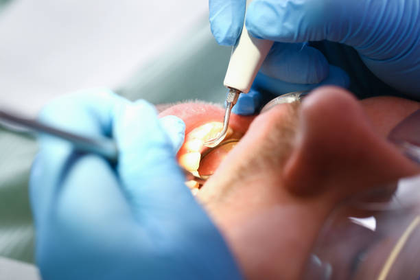 Best Emergency Dental Care for Abscessed Tooth in Woodlake, VA